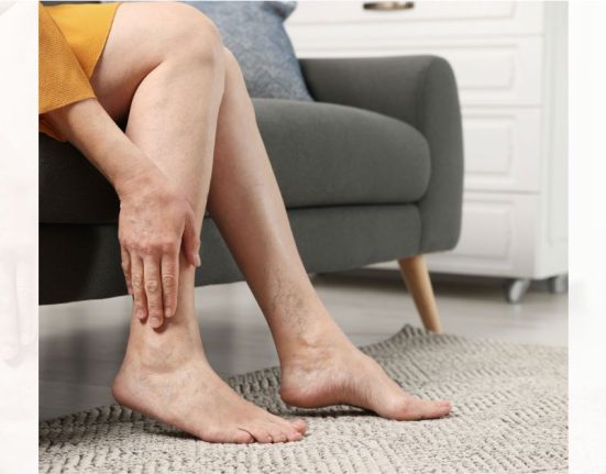 varicose vein surgery