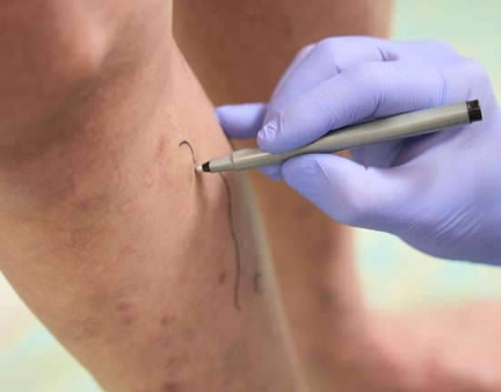 varicose veins treatment singapore