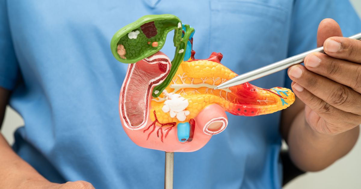 Types of Pancreatic Cancer