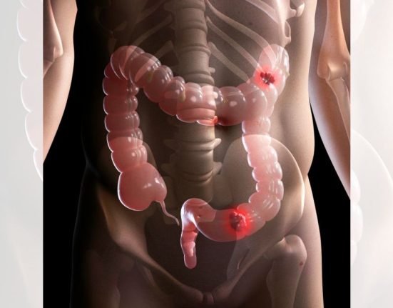colorectal cancer screening singapore