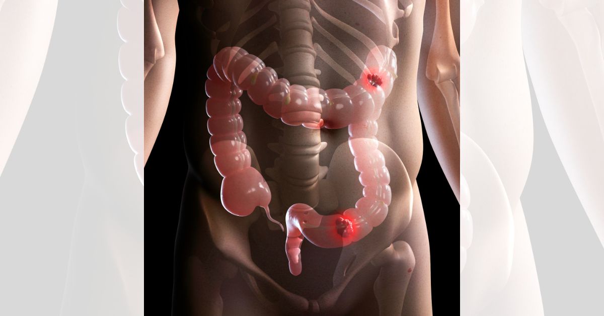 colorectal cancer screening singapore