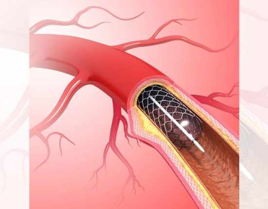 what is mechanical thrombectomy