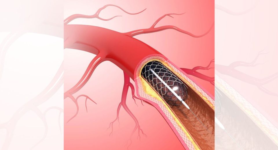 what is mechanical thrombectomy