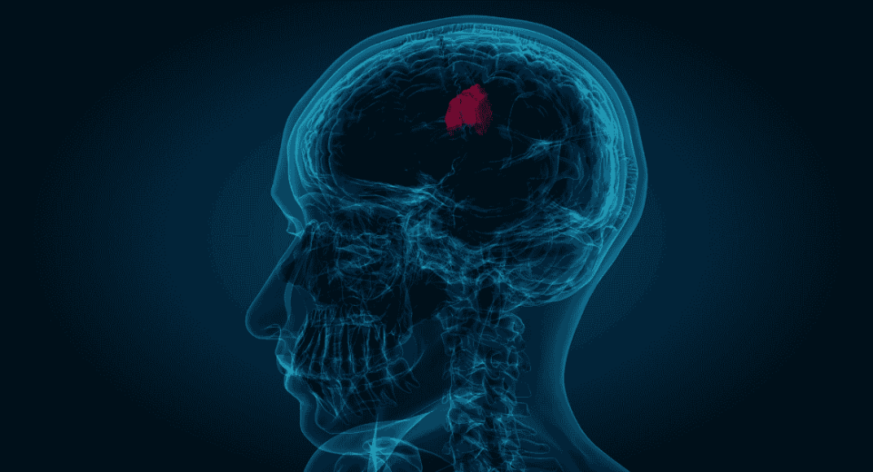 Brain Tumour Surgery in Singapore: Costs, MediSave, and Insurance Coverage
