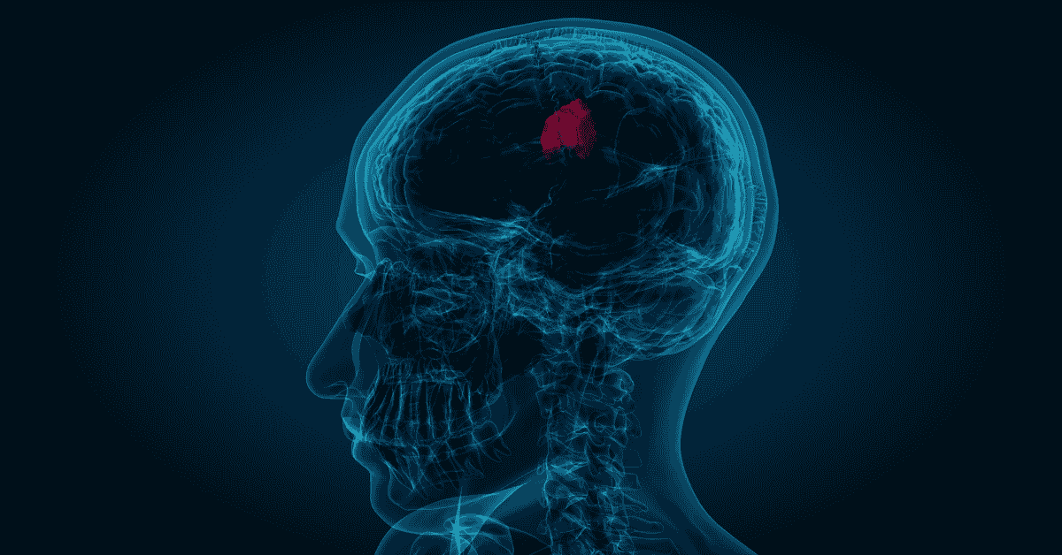 Brain Tumour Surgery in Singapore: Costs, MediSave, and Insurance Coverage