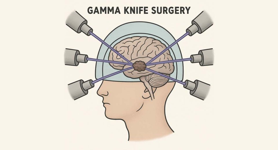 Gamma Knife Radiosurgery