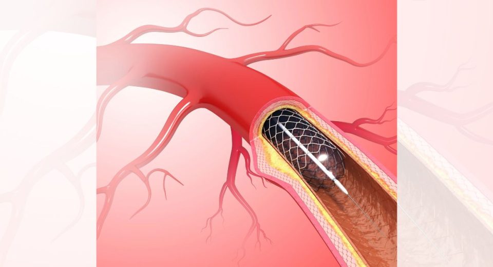 Peripheral artery disease Singapore Treatment