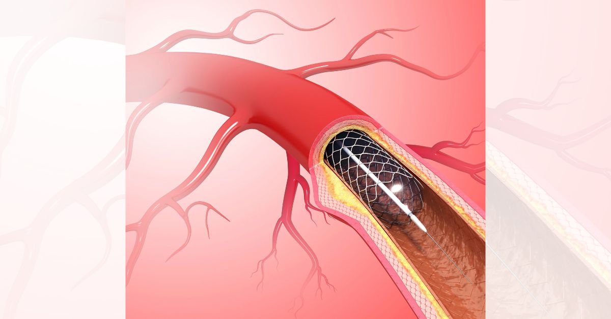 Peripheral artery disease Singapore Treatment