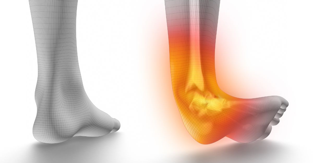 ankle sprain surgery