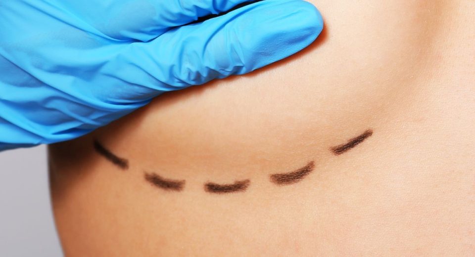 breast augmentation scars