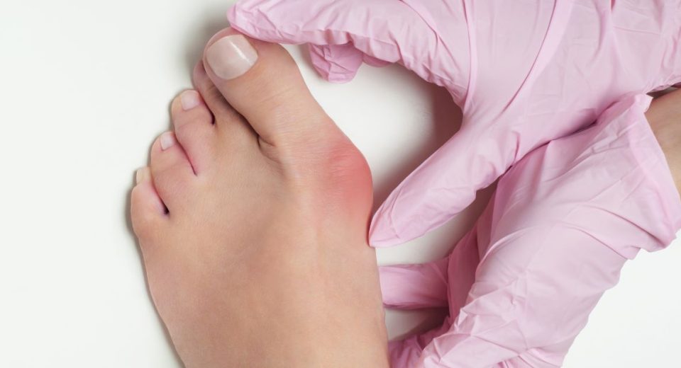 bunion surgery singapore price