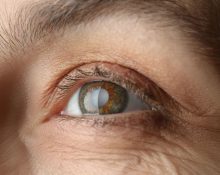 cataract