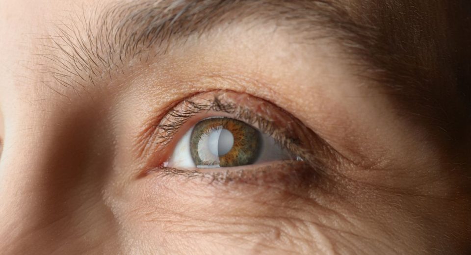 cataract