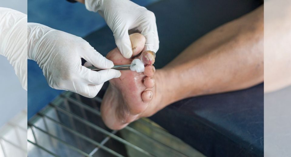 Early Stage Diabetic Foot Ulcer