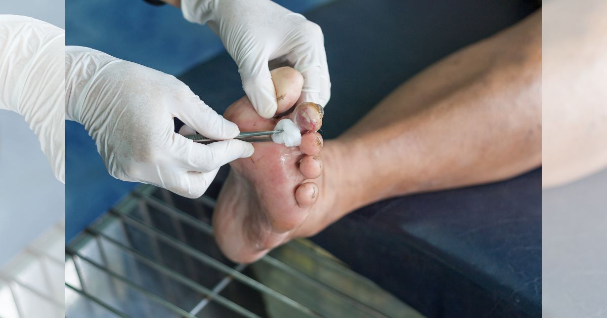 Early Stage Diabetic Foot Ulcer