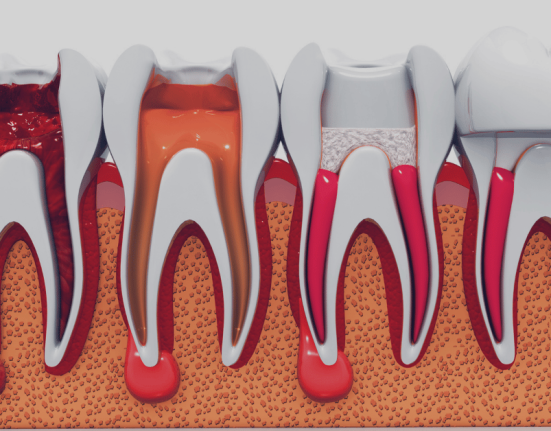 Root Canal and Crown: What You Need to Know About Restoring Your Tooth