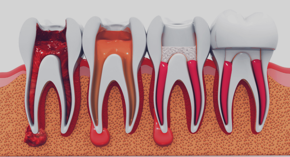 Root Canal and Crown: What You Need to Know About Restoring Your Tooth