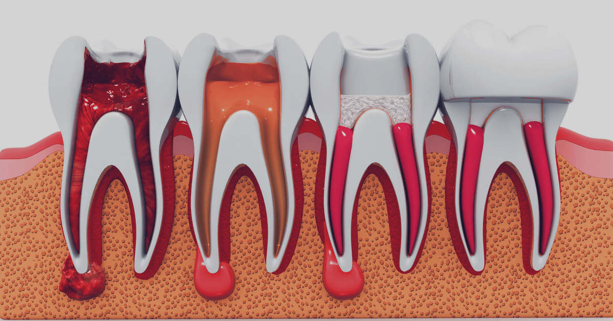 Root Canal and Crown: What You Need to Know About Restoring Your Tooth