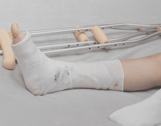 Bone Fracture in Singapore: Causes, Symptoms, and Treatments