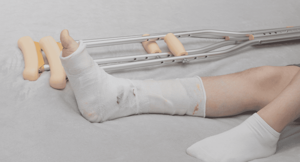 Bone Fracture in Singapore: Causes, Symptoms, and Treatments