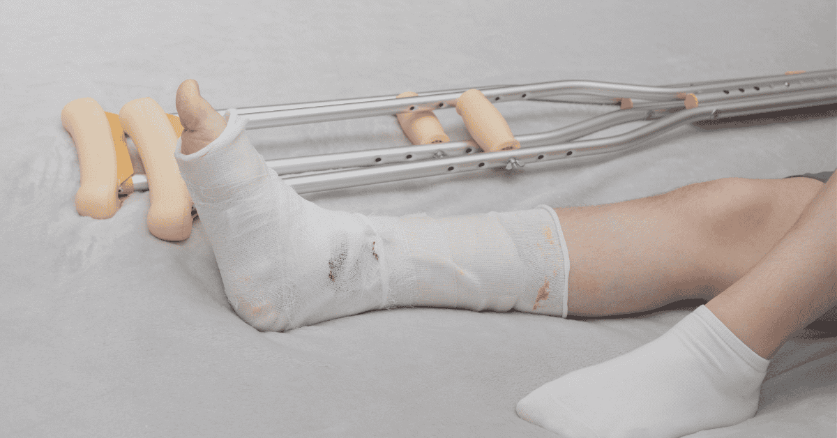 Bone Fracture in Singapore: Causes, Symptoms, and Treatments