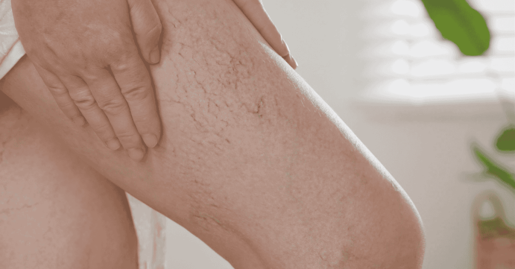 Varicose Veins and Deep Vein Thrombosis: Key Differences