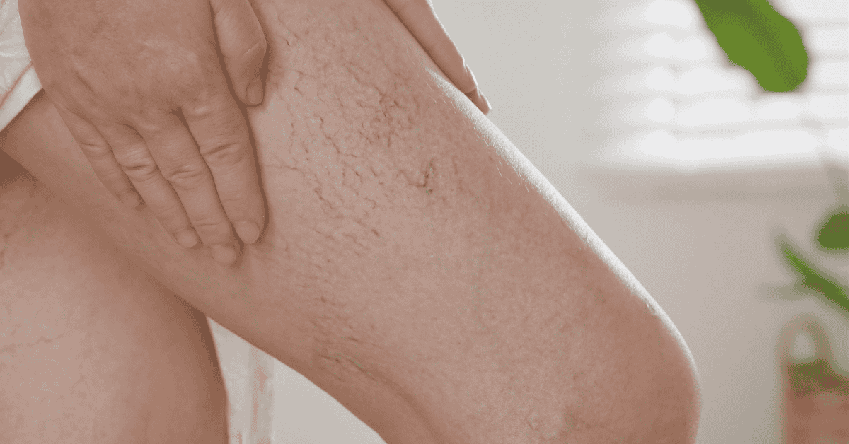Varicose Veins and Deep Vein Thrombosis: Key Differences