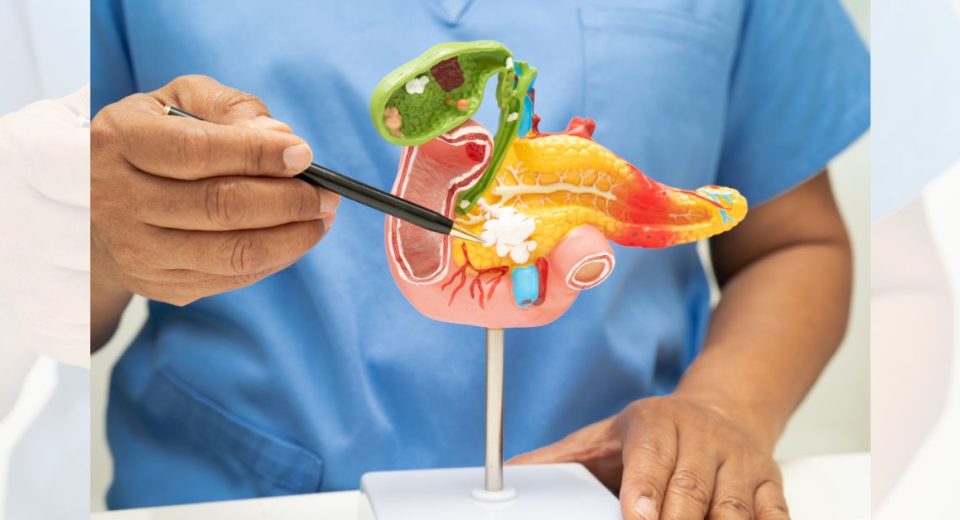 Gallstone removal surgery