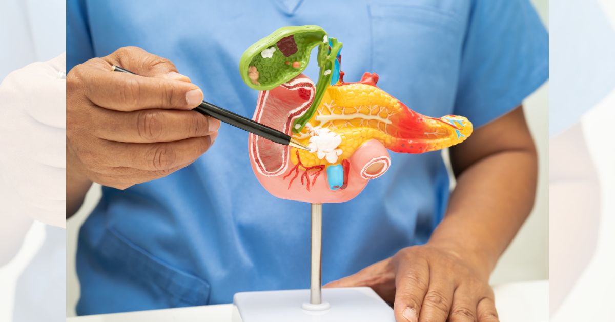 Gallstone removal surgery
