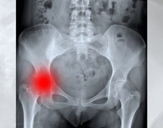 Hip Fracture In Elderly and Osteoporosis