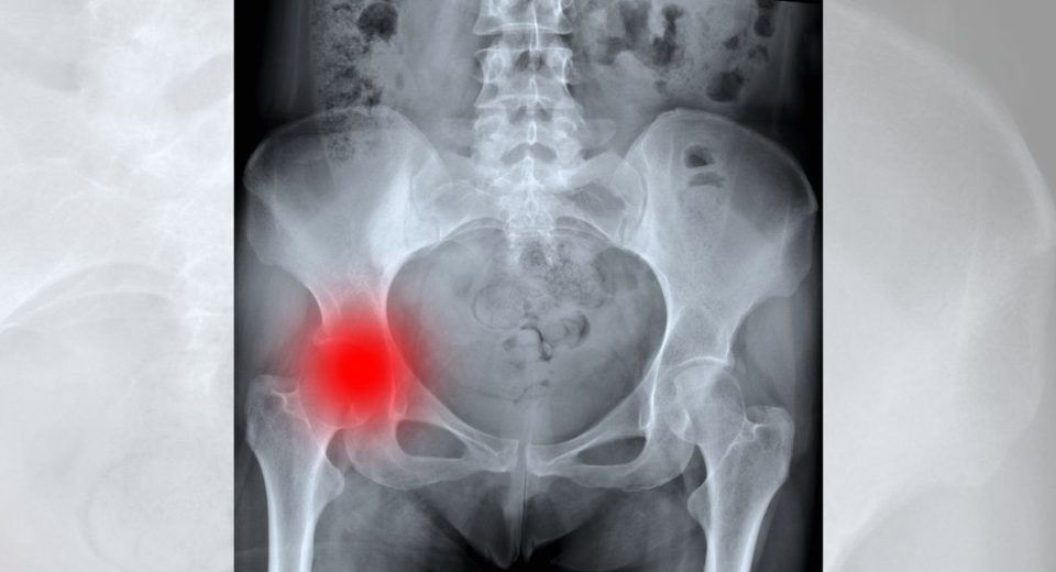 Hip Fracture In Elderly and Osteoporosis