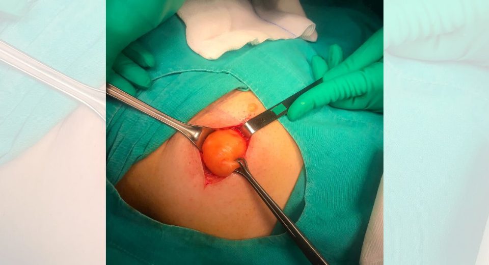 Sebaceous cyst removal