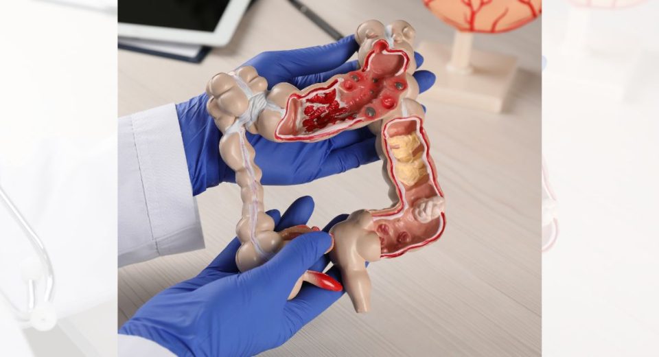 Colectomy