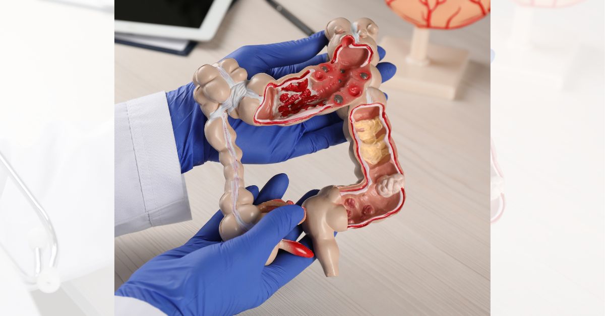 Colectomy
