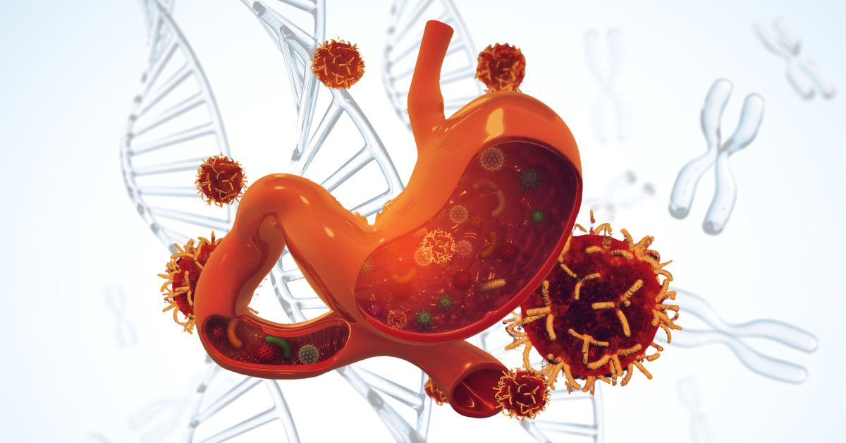 DNA and Stomach Cancer Risk