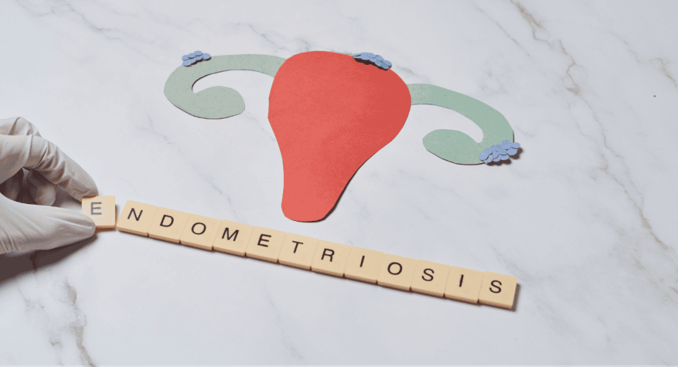 Endometriosis Classification: Understanding the Stages of the Condition