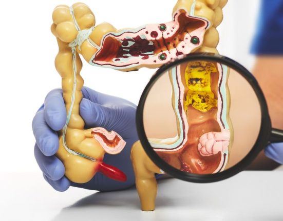 How To Prevent Colorectal Cancer