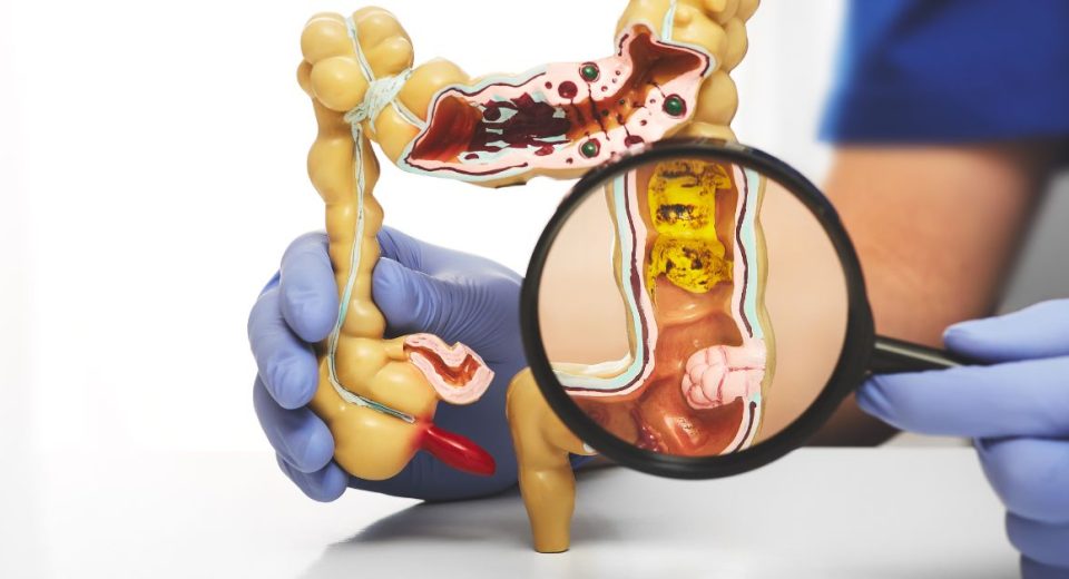 How To Prevent Colorectal Cancer