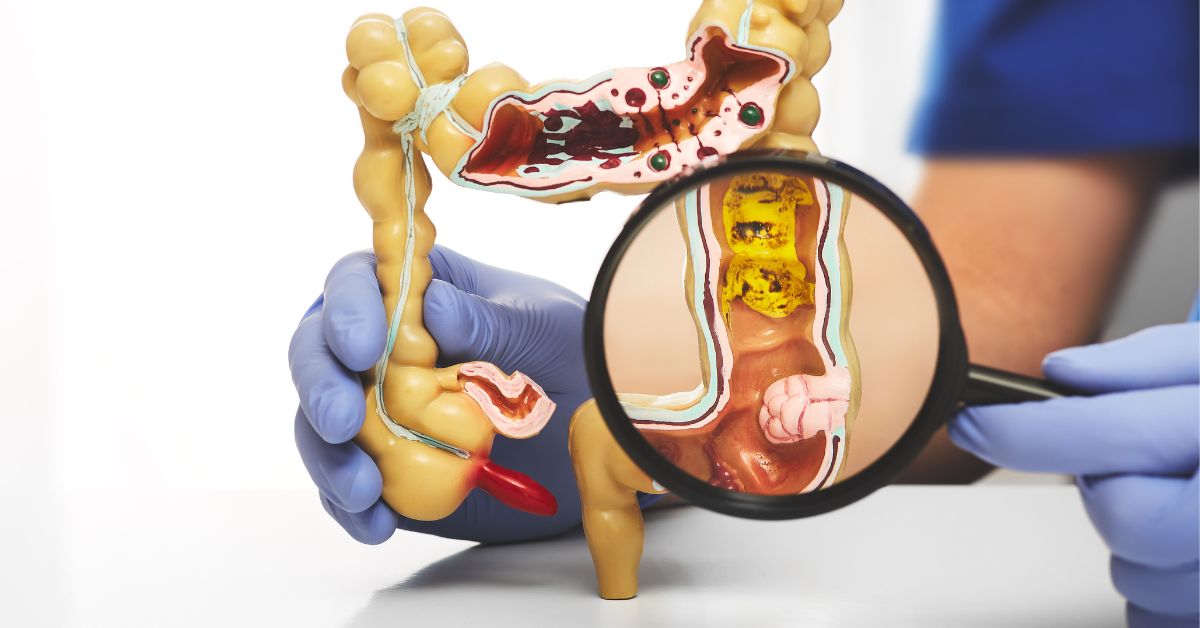 How To Prevent Colorectal Cancer