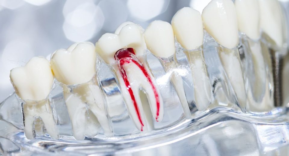 Root Canal Retreatment