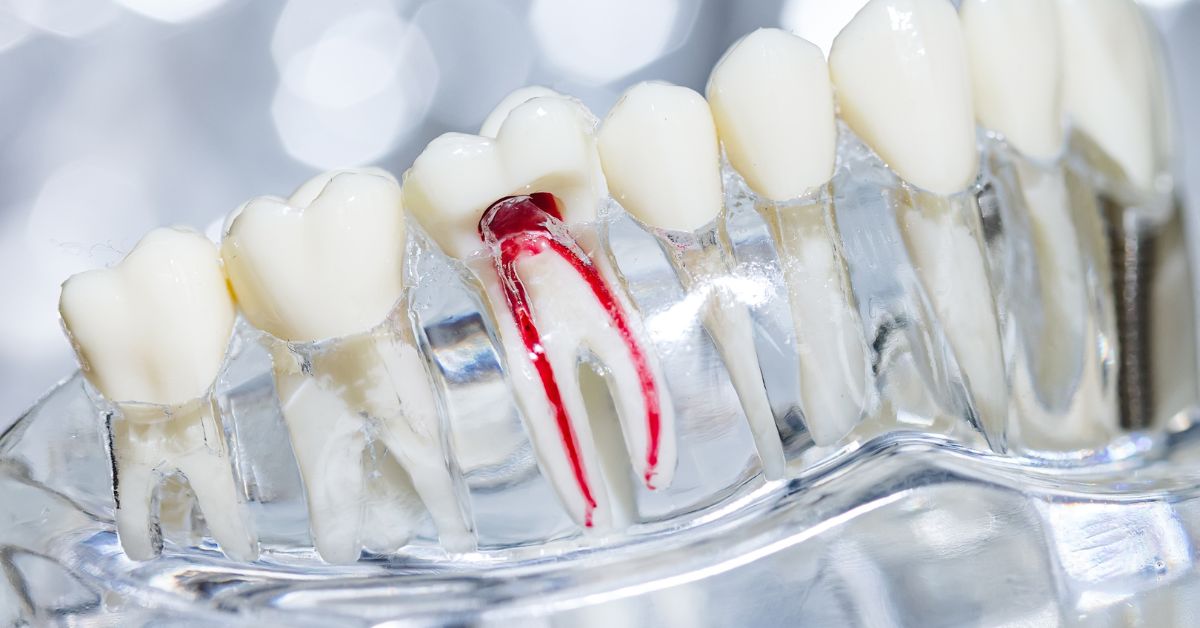 Root Canal Retreatment