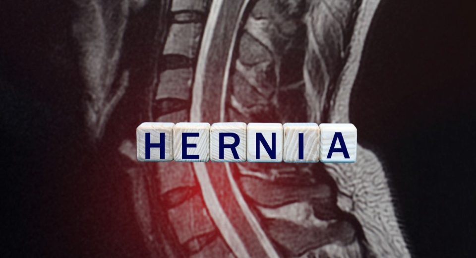 Types of hernia