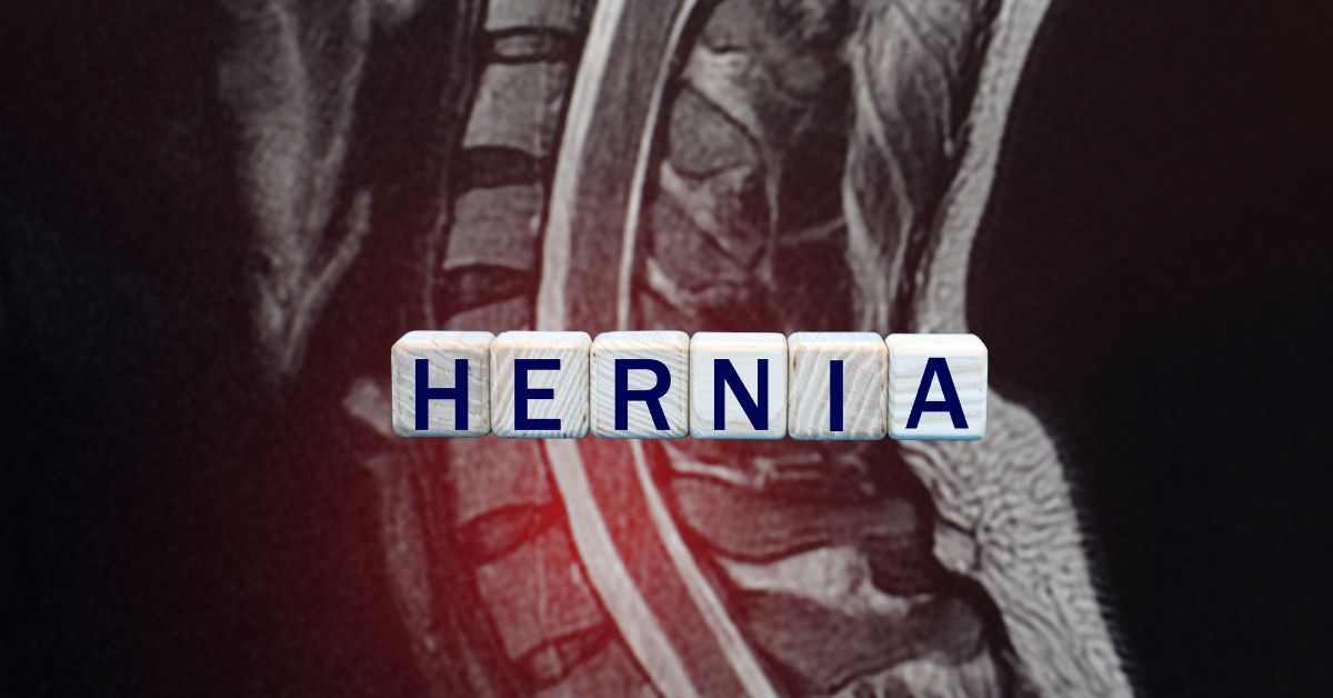 Types of hernia