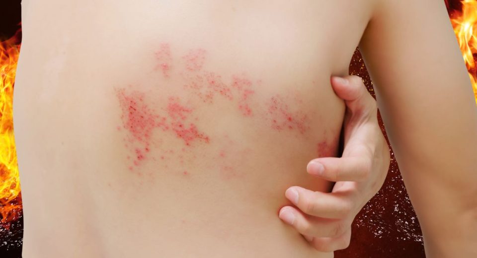 What is shingles - myths and facts