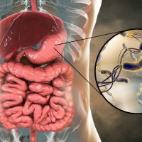 H. pylori bacteria infection