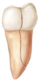 Split tooth