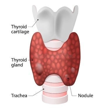 Thyroid nodule