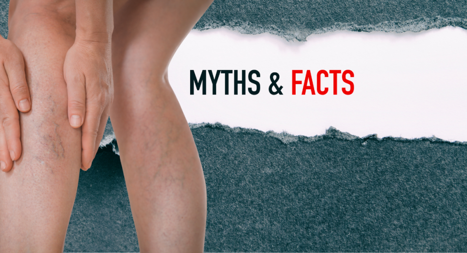 Varicose Veins Myths And Truths
