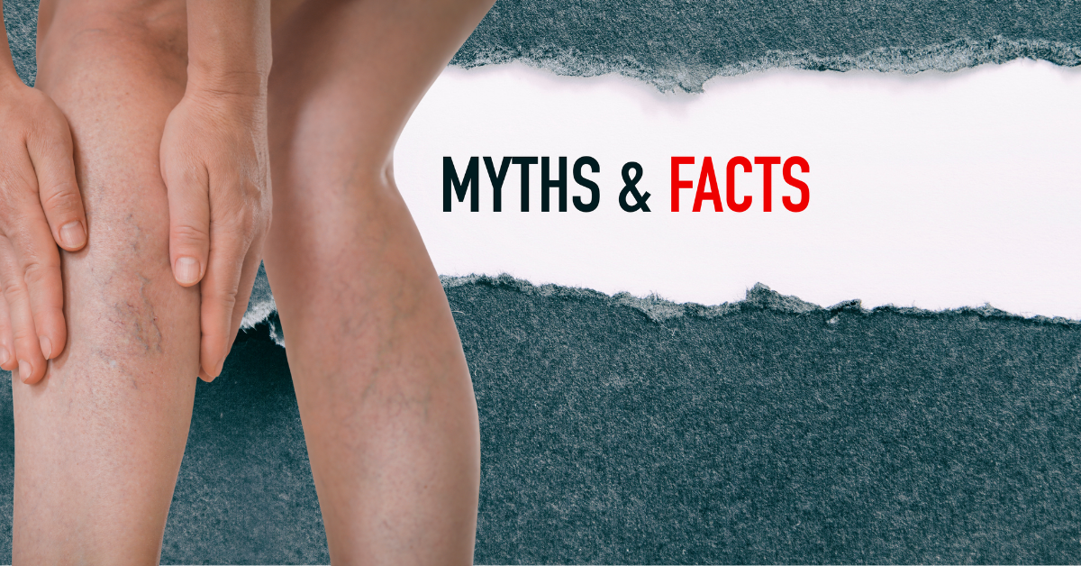 Varicose Veins Myths And Truths
