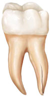 Vertical Root Fracture